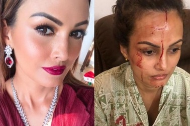 Sốc với ảnh minh tinh Ấn Độ bị chồng đánh chảy máu đầu