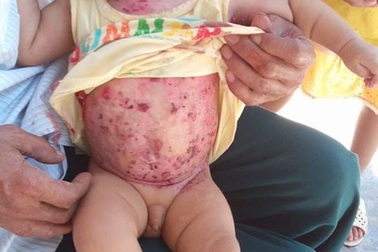 Thương hai anh em hàng ngày đau đớn vì bệnh "lột da ếch"