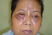 Thêm hai nạn nhân của phẫu thuật thẩm mỹ chui