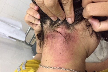 Kiến ba khoang tràn vào bệnh viện tấn công bệnh nhân