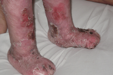 Đau đớn những sinh linh “bỏng” từ trong bụng mẹ