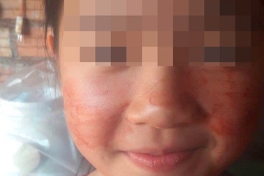 Mắc bệnh lạ, bé 11 tuổi “đổ mồ hôi máu”