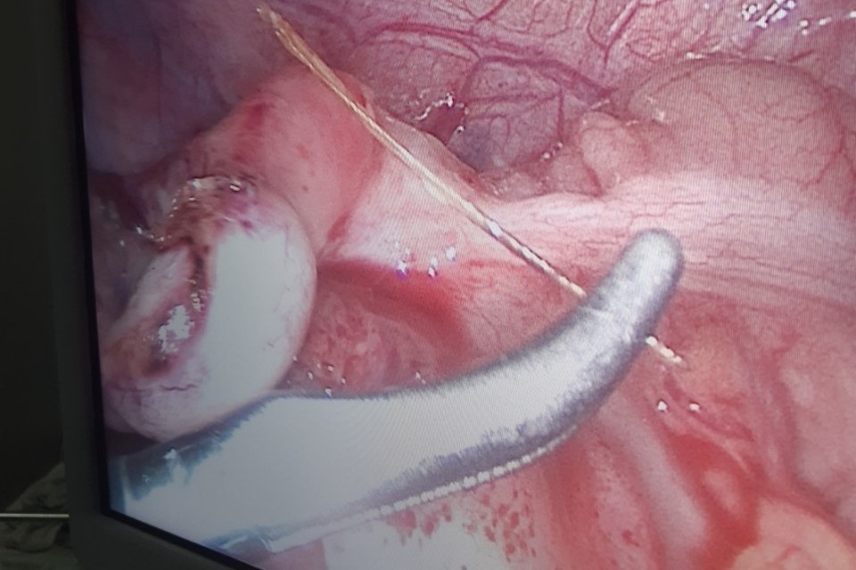 Cà Mau: Bé 13 tuổi bị xương cá đâm thủng ruột thừa hiếm gặp - 1 Cà Mau: Bé 13 tuổi bị xương cá đâm thủng ruột thừa hiếm gặp - 1