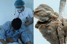 Sán lúc nhúc trong phổi thanh niên 19 tuổi vì món ăn nhiều người Việt thích