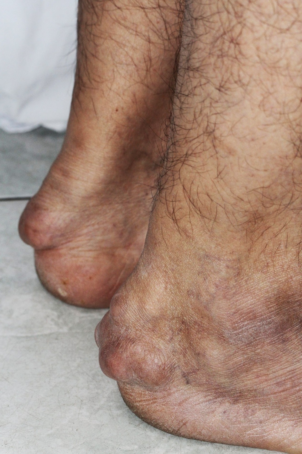 Người đàn ông ở TPHCM mổ 15 lần vì đột biến chưa từng báo cáo trên thế giới - 2 Người đàn ông ở TPHCM mổ 15 lần vì đột biến chưa từng báo cáo trên thế giới - 2