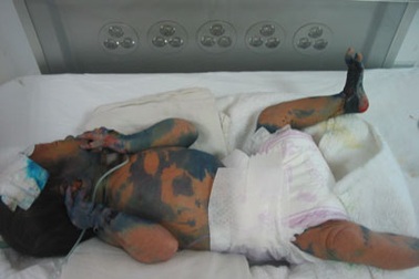 Thêm trường hợp đau lòng của bé 8 ngày tuổi mắc bệnh “lột da ếch” 