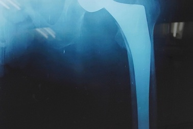 Trượt té trong nhà, cụ bà 106 tuổi phải thay cổ xương đùi