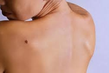 Thủ phạm hàng đầu gây ung thư da