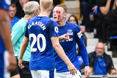 Lĩnh trọn cùi chỏ, Rooney máu chảy đầm đìa