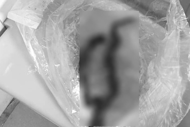 Người đàn ông được đưa đến bệnh viện cùng… 1 đoạn ruột đựng trong túi bóng