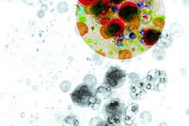 Ai có nguy cơ mắc sỏi thận?