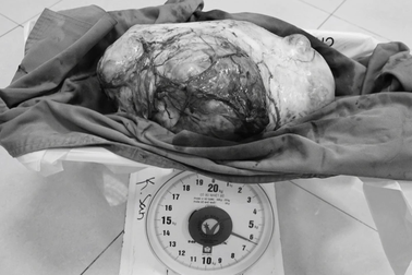 Cô gái có khối u buồng trứng "khổng lồ" nặng 6,5 kg