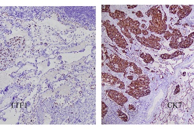 Hiếm gặp: Phát hiện 2 loại ung thư trên cùng một thùy phổi
