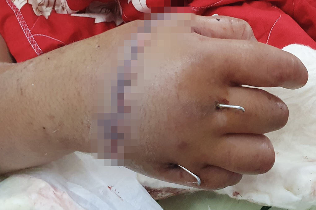 Mâu thuẫn với bạn ở trường, nam sinh 12 tuổi bị chém đứt lìa tay - 2 Mâu thuẫn với bạn ở trường, nam sinh 12 tuổi bị chém đứt lìa tay - 2