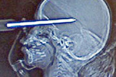 2 tuổi, thoát chết sau khi bị tua vít xuyên vào đầu