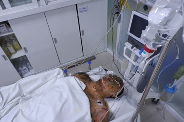 Cabin bốc cháy sau tai nạn, 3 người trên xe bị thương nặng