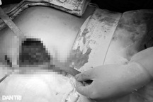 Tiêm chất làm đầy "vòng ba", cô gái ở TPHCM gánh hậu quả nặng nề