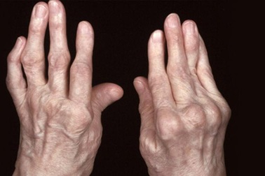 4 hậu quả khôn lường nếu không sớm điều trị viêm đa khớp