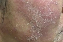 Hãi hùng những “gương mặt ma” vì kem trộn làm đẹp thần tốc