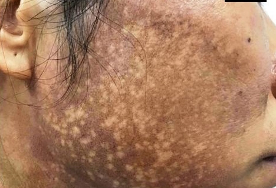 Da mặt như “bánh đa vừng đen” vì bôi kem trộn làm trắng - 1 Da mặt như “bánh đa vừng đen” vì bôi kem trộn làm trắng - 1