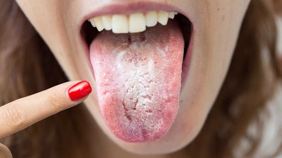 Lưỡi có dấu hiệu này, không đau ốm gì cũng cần đi khám ngay - 1 Lưỡi có dấu hiệu này, không đau ốm gì cũng cần đi khám ngay - 1