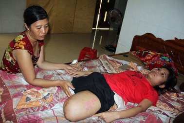 “Cô giáo mầm non tương lai bị tai nạn cụt đôi chân” sắp có việc làm