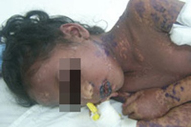 Cứu sống một trẻ bị dị ứng thuốc