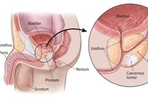 Dấu hiệu bí đái ở nam giới có thể cảnh báo ung thư tiền liệt tuyến