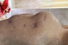 Nhiều người suýt chết vì tưởng "bụng bia"