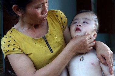 Thương cảnh mẹ nghèo ôm con bị bệnh não úng thuỷ xin ăn từng bữa