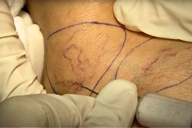 Điều trị suy giãn tĩnh mạch và những biến chứng tiềm ẩn cần biết