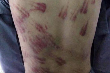 Cháu bé mồ côi bị sư thầy đánh bầm tím khắp cơ thể