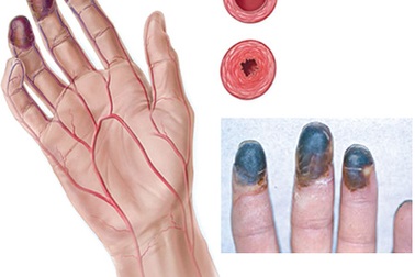 Suýt mất cánh tay do tắc động mạch nhưng tưởng đau xương khớp