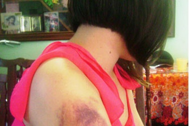 Một nữ sinh tố bị cha hành hung dã man