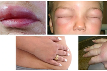 Nhiều khó khăn trong chẩn đoán, điều trị bệnh phù mạch di truyền