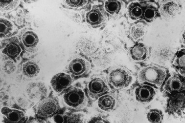 Táo bón là do vi rút… herpes