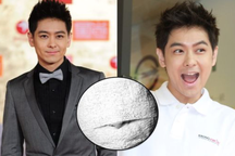 Lâm Chí Dĩnh băng kín mặt sau phẫu thuật, khó lấy lại gương mặt xưa