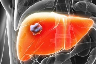 Phát hiện mới: Tế bào Kupffer “nổi loạn” gây bệnh cho gan