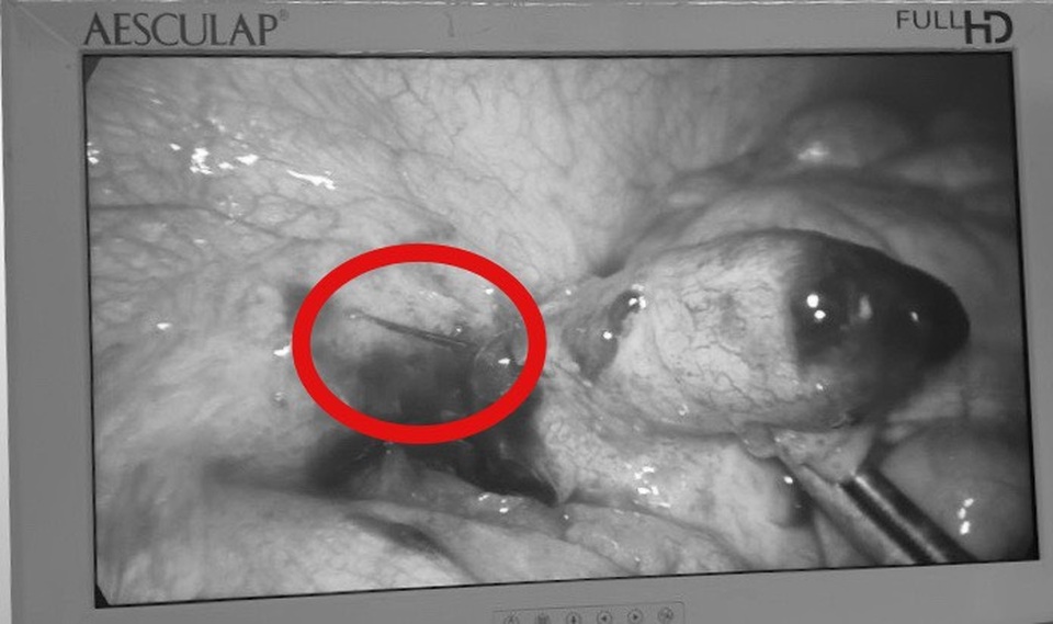 Xương cá đâm thủng ruột, phòi mủ ra ổ bụng - 1 Xương cá đâm thủng ruột, phòi mủ ra ổ bụng - 1