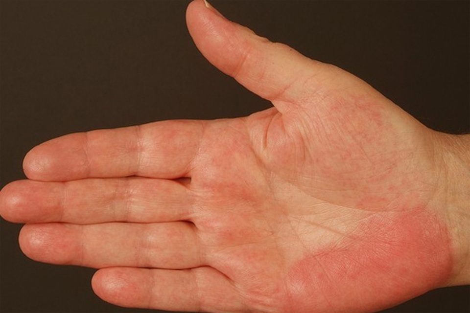 3 biến đổi trên da cảnh báo bệnh ung thư gan - 3 3 biến đổi trên da cảnh báo bệnh ung thư gan - 3