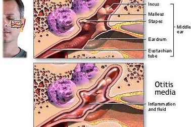 Tại sao lại dễ viêm tai?