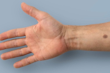 Thiết bị độc đáo cảnh báo ung thư qua... nốt ruồi