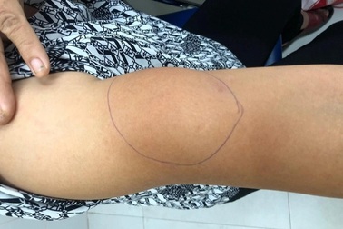 Phát hiện khối u từ tình trạng cánh tay sưng đau bất thường