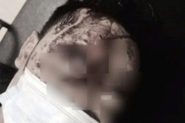 Anh rể nửa đêm đột nhập vào nhà đánh em vợ nhập viện