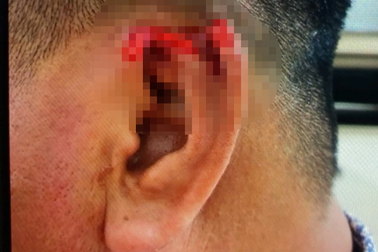 Có bồ mới, người đàn ông bị "vợ lớn" cắn đứt tai giữa buổi tiệc