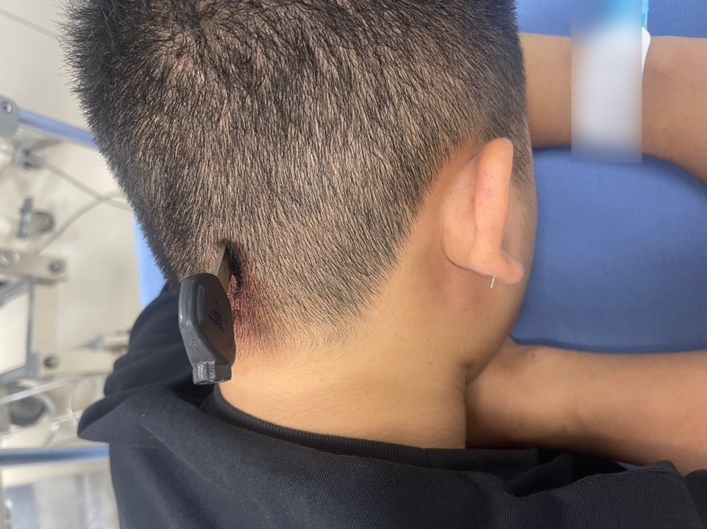 Hy hữu nam thanh niên bị chìa khóa cắm vào đầu - 1 Hy hữu nam thanh niên bị chìa khóa cắm vào đầu - 1