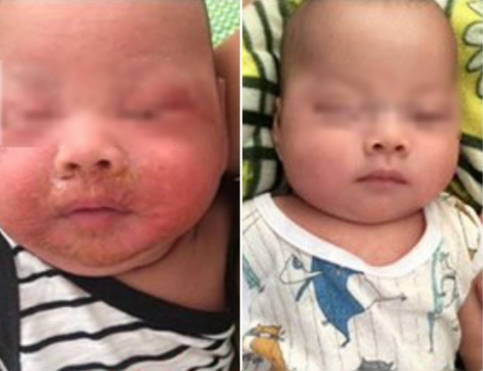 Nhiễm tụ cầu, bé 4 tháng tuổi bong loét da mặt do mẹ đắp thuốc lá - 1 Nhiễm tụ cầu, bé 4 tháng tuổi bong loét da mặt do mẹ đắp thuốc lá - 1