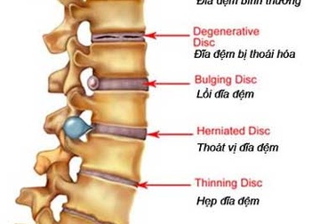 Thoái hóa cột sống - Điều trị không khó!