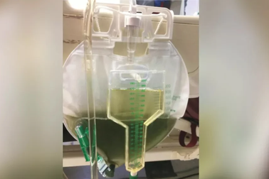 Nước tiểu của đàn ông chuyển sang… màu xanh khi nằm viện