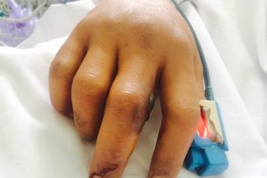 Cần Thơ: Cứu sống 2 bệnh nhân bị rắn cắn nguy kịch